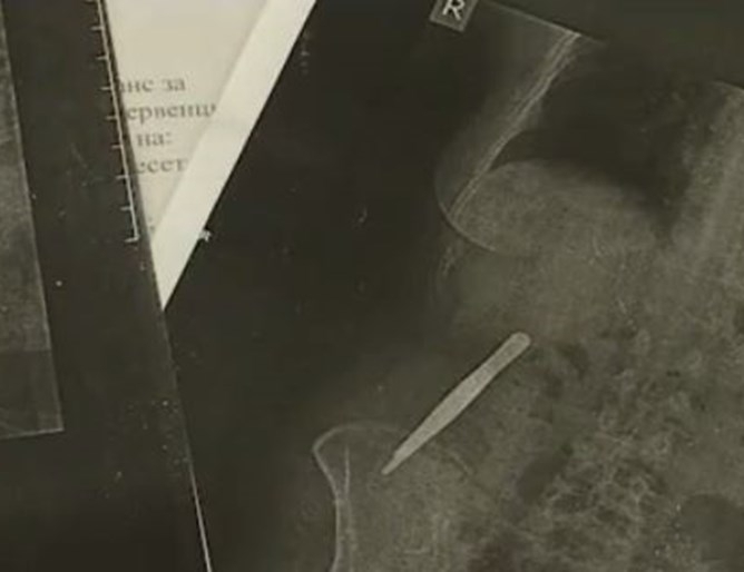 Медицинска сестра 3 г е живяла с 15 сантиметрова пинсета