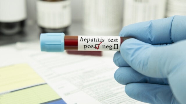 От изследваните 4 съмнителни проби на новия хепатит има една