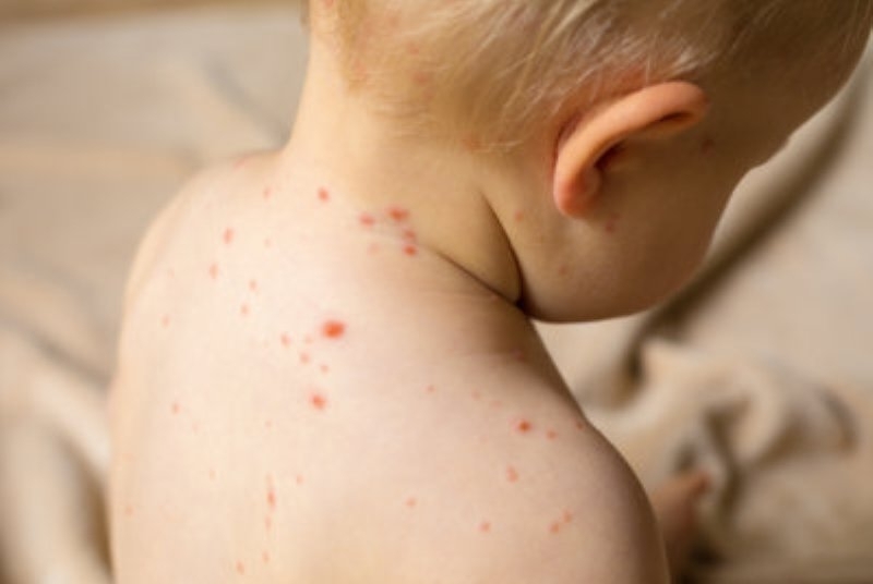 Наблюдава се рязко увеличение на броя на болните от варицела през последните