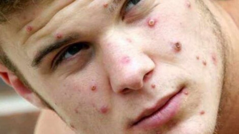 Маймунската шарка изглежда се разпространява от човек на човек в