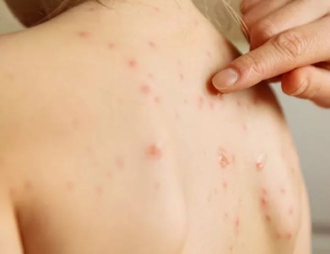 Опасност от епидемия от морбили има най вече там където децата и