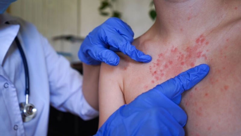 Пазете се! Регистрираха още заразени с морбили във Враца и Плевен, болниците са почти пълни