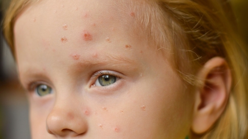 Намалява броят на болните от скарлатина и варицела във Враца