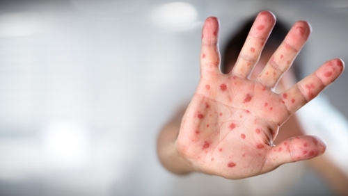 Случаите на морбили у нас станаха 460 и около 100