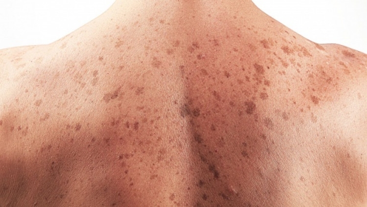 Ракът на кожата се диагностицира ежегодно при 16 хиляди британци