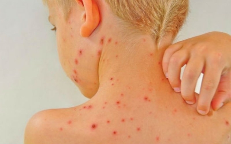 Бум на варицела се отчита във Врачанско научи BulNews bg Само