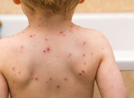 Потвърден е първият случай на морбили в Дупница съобщи БНР