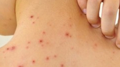 За периода изминалата седмица регистрираната в РЗИ Варна остра