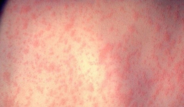 Случаите на морбили в България вече са пет обяви проф