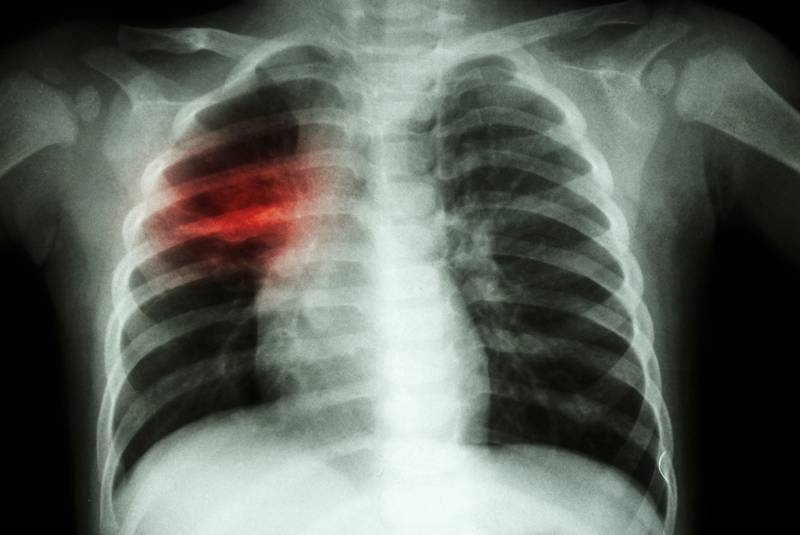 Бум на болни от туберкулоза е отчетен във Врачанско сочи