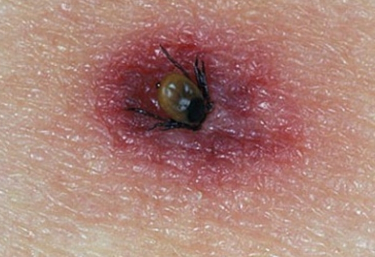 Петима ухапани от кърлежи са потърсили помощ само за една