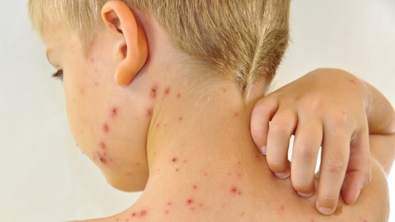Варицелата продължава да върлува из Враца научи BulNews bg През последната