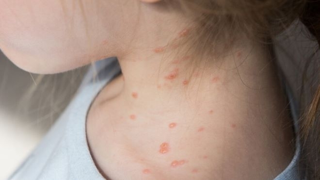 Намаляват случаите на варицела у нас показват данните на Националния център