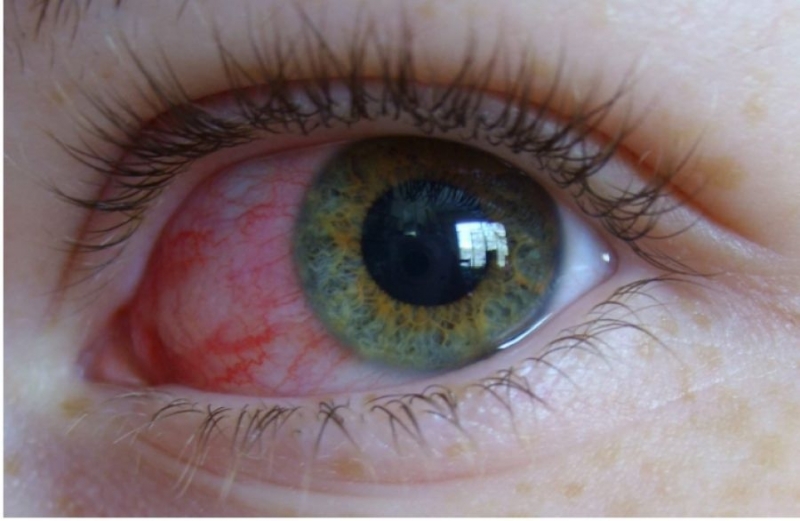 През пролетно летния сезон е пикът на заболяването конюнктивит Общото между