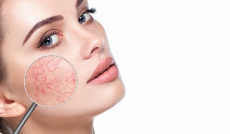 Типичният обрив на розацеята обхваща бузите и носа под формата