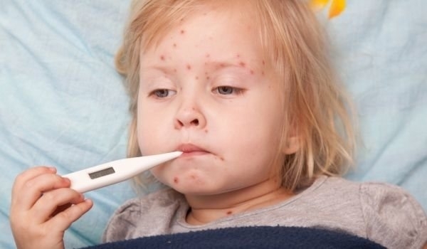 Повишаване на болните от варицела във Врачанско e отчетена през