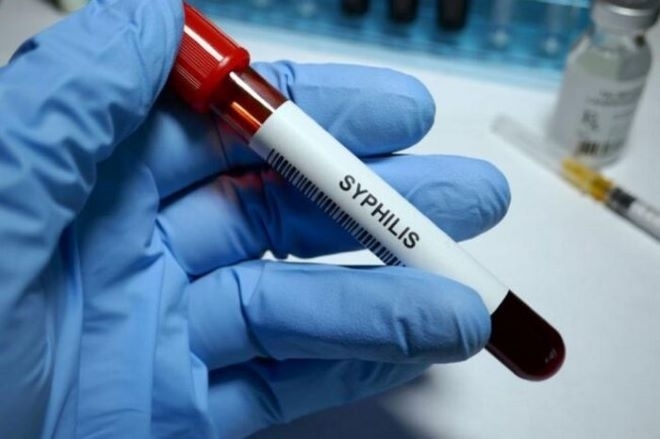 Три случая на сифилис в област Монтана само за седмица.