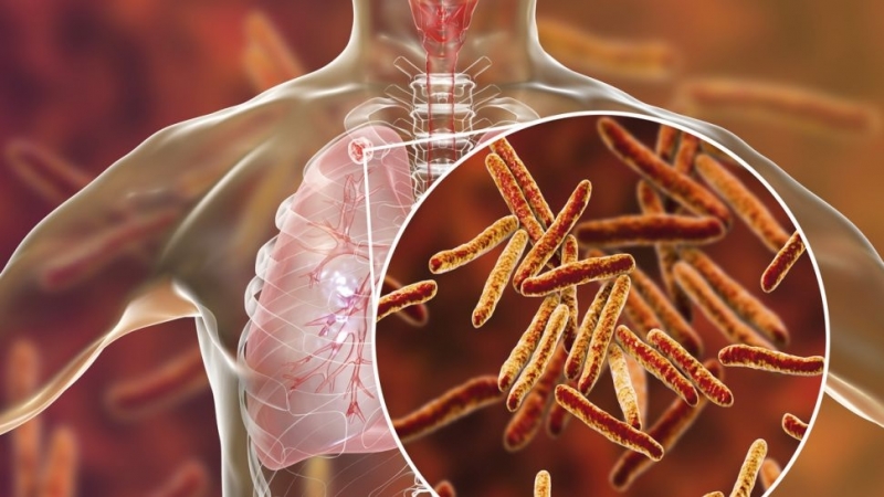 Двойно повече са новооткритите случаи на туберкулоза през 2022 в