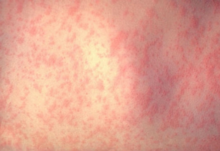 Нивата на дребна шарка в Европа са рекордно високи Това