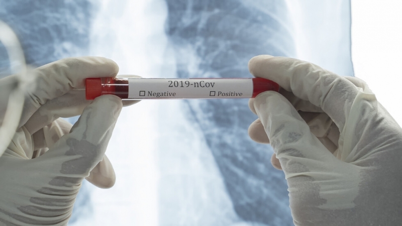 1024 са потвърдените случаи на COVID 19 у нас по данни