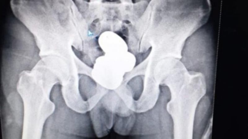 Контрабандист скрил почти един килограм златна паста в ректума си