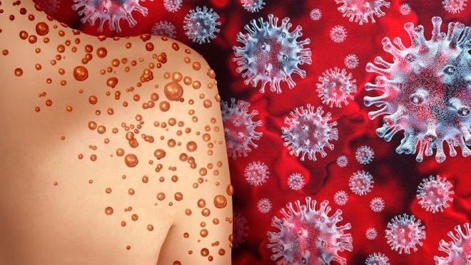 Първите симптоми при маймунската шарка са като на нормална инфекция