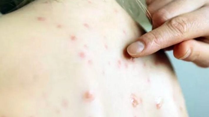 Общо 14 случая на варицела и скарлатина са регистрирали здравните