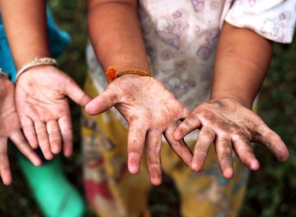 Хепатит А известен като болестта на мръсните ръце се е