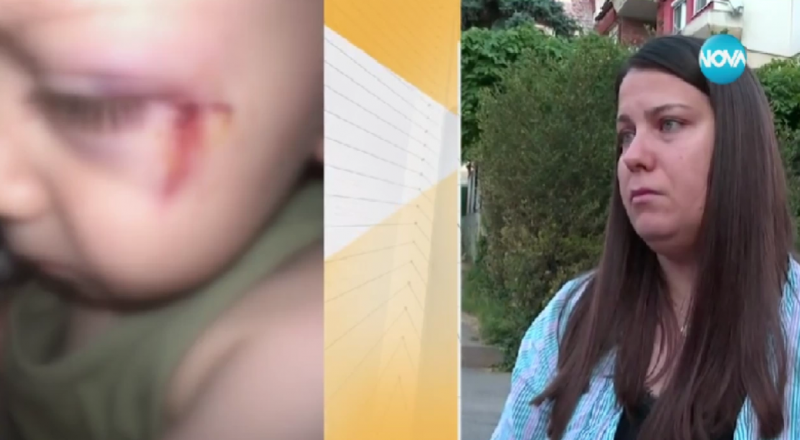 2 годишно дете е с шевове на лицето след инцидент в