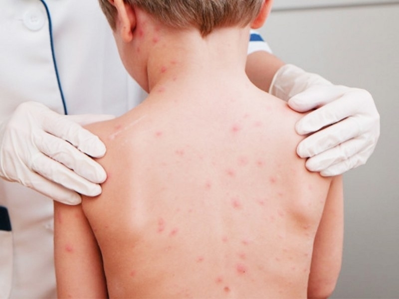 Варицела продължава да върлува във Враца сочи седмичният информационен бюлетин