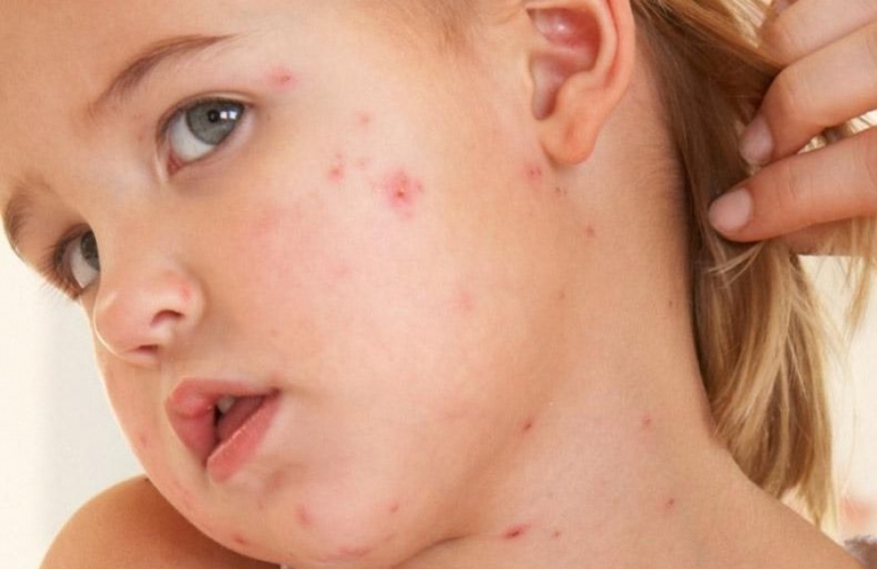 Имунизационният обхват срещу морбили с първа и втора доза в България е незадоволителен