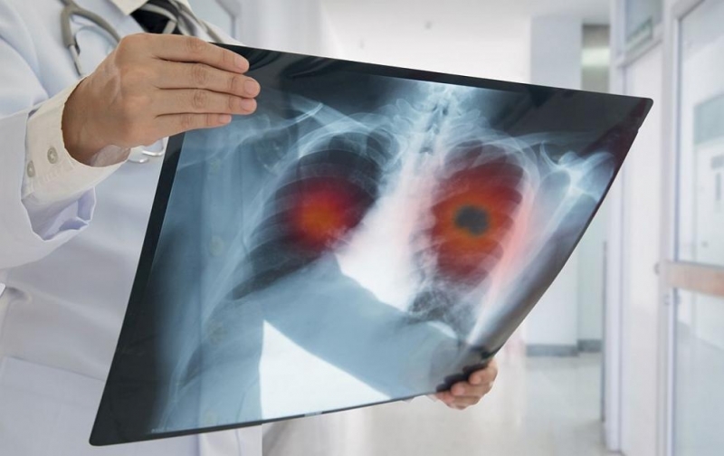 Ракът на белия дроб е едно от петте най често срещани