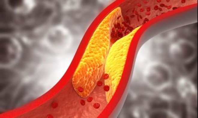 Високият холестерол може да засегне всеки и е сериозно състояние, което увеличава риска