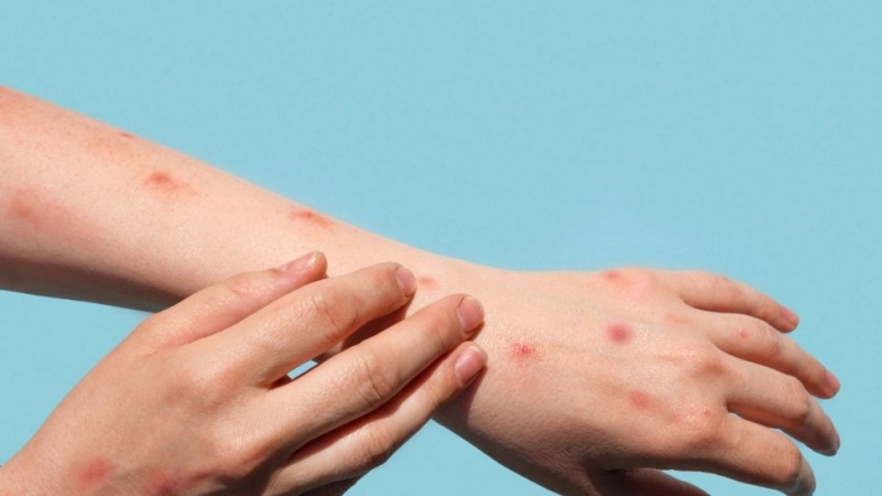 Пети случай на заразен с маймунска шарка у нас е