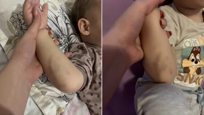 Родители от Плевен твърдят че детето им е малтретирано в детска ясла То има