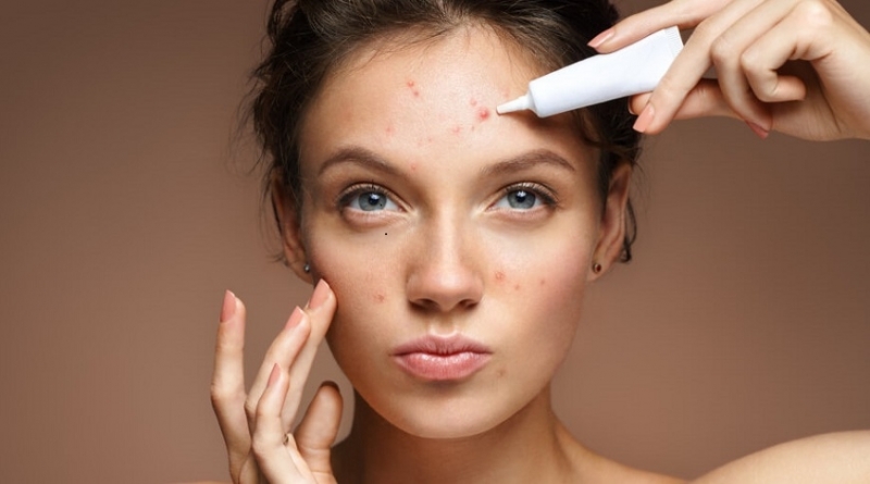 Акнето е едно от най често срещаните кожни проблеми Важно е да