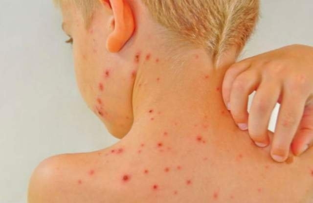 Бум на варицела се отчита във Врачанско научи BulNews bg През