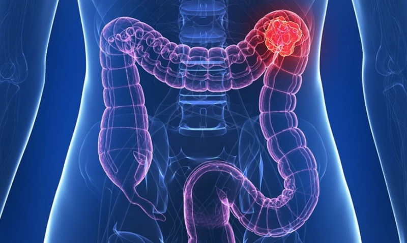 Случаите на рак на дебелото черво сред хората на възраст между 25