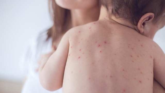 Леко спада броят на новите случаи на заразени с варицела