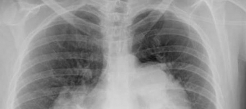 Британски учени направиха нова огромна крачка в борбата с рака Учените