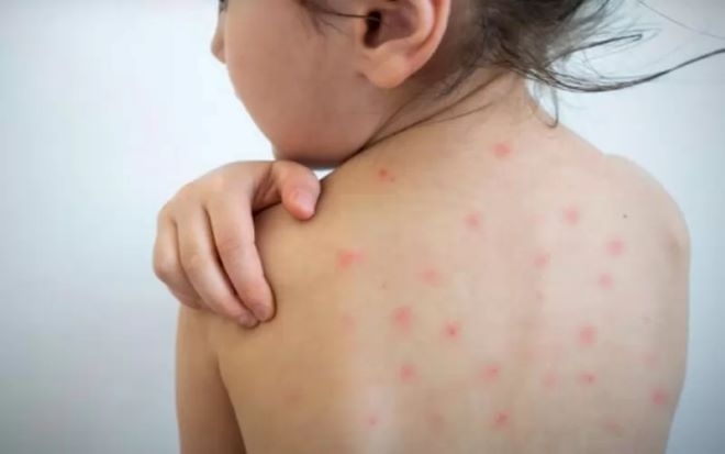 Случаите на морбили в България нараснаха до 101, най-много са в област Враца