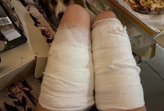 Нелепо химическо изгаряне от течност изтекла от калъфа на телефона