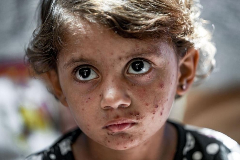 Постоянен поток от нещастни деца и разтревожени родители се вливат в дерматологичния