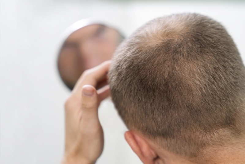 Ново лечение срещу плешивост възстановява растежа на косата с 539%