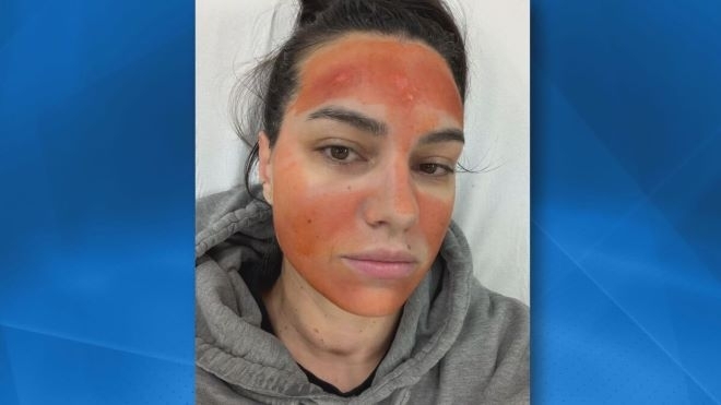 Една процедура за освежаване на кожата рекламирана като напълно безбидна