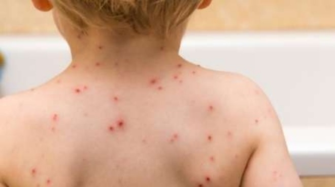 Над 140 хил души са починали от морбили в световен