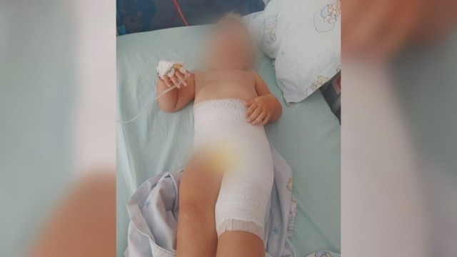 2-годишно дете е получило изгарания по време на престоя си