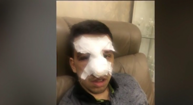 Агресия на футболен мач Момче пострада тежко след побой на