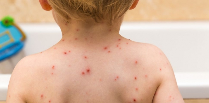 Бум на варицела се отчита във Врачанско научи BulNews bg През