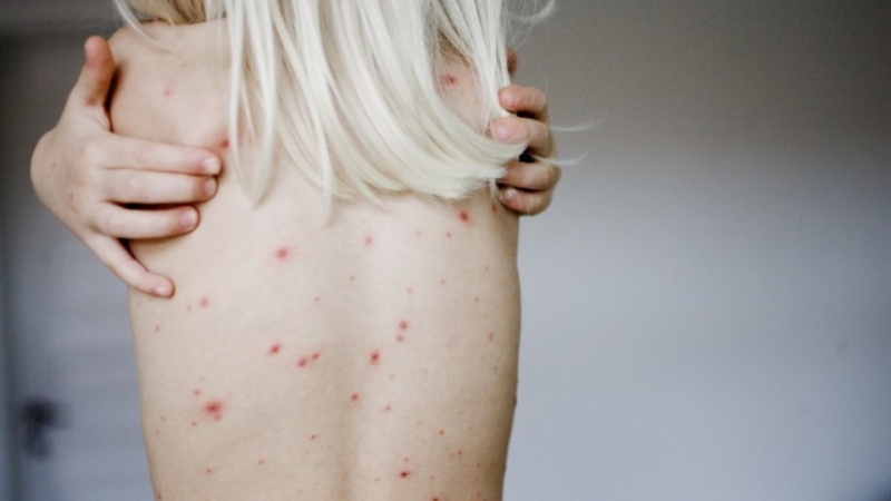 Двама врачани са се заразили със сифилис съобщиха от Регионалната